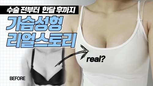 가슴성형 리얼스토리